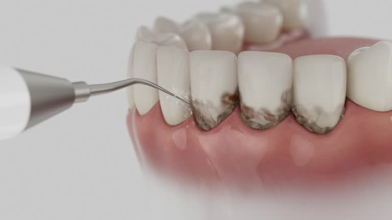 Trusted Wisdom Tooth Removal service in Pleasant Hill, CA - Dentist Open Now